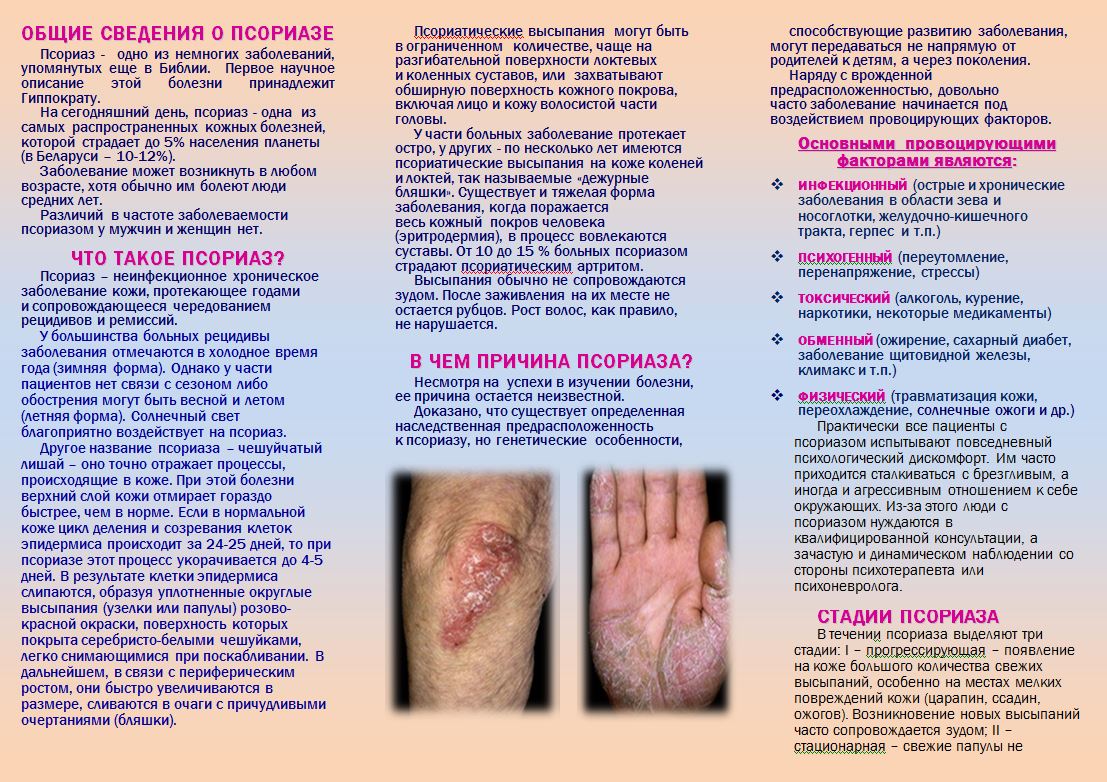 псориаз